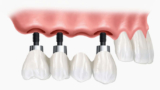 The Features of Family Dentistry in Newton