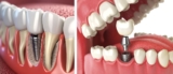 Implant Dentistry: Mapping Every Step to a Stable Bite