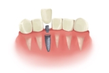 Dental Implants for Seniors: A Safe and Effective Solution