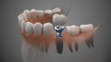 Tips for Managing Discomfort After Dental Implant Surgery