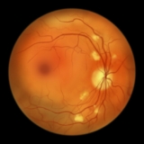 How Diabetic Retinopathy is Diagnosed and Treated