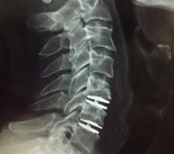 Why Choose Disc Replacement Surgery in Mumbai at Synapse Spine?