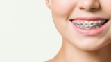 Do Braces Hurt? Understanding Discomfort and Relief Tips
