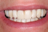 Do Dental Veneers Require Special Maintenance or Care?