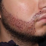 Does Beard Hair Transplantation Leave Scars on the Face or Donor Area