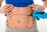 Does Liposuction in Dubai Hurt What to Expect During and After Surgery