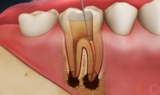 Understanding Root Canal Treatment: A Comprehensive Guide
