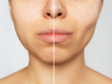 The Charm of Dimples: Achieving the Perfect Smile with Dimple Creation Surgery