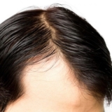 خدمات زراعة شعر التاج في دبي: عزز مظهرك