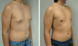 Gynecomastia Surgery in Delhi