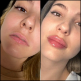 Top Benefits of Consulting the Best Juvederm Fillers Dermatologists in Dubai