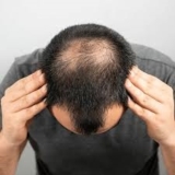 FUE vs FUT: Which Hair Transplant Method is Right for You in Dubai?
