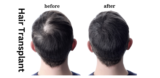 Hair Transplantation – The Best Solution to Get Rid of Your Baldness