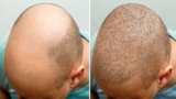 Finding the Best Hair Transplant Prices in Riyadh