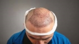What to Expect During Your Hair Transplant in Riyadh Consultation