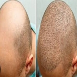 Get Ahead of Hair Loss with Riyadh’s Leading Hair Transplant Clinics