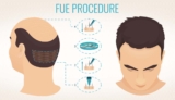 Bold Looks Begin with Bold Choices – Hair Transplant Treatment That Changes Everything