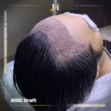 The Advantages of Hair Transplantation for Riyadh Residents