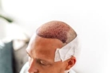 What to Expect Before & After a Hair Transplant in Dubai