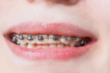How Dental Braces Can Help with Teeth Alignment and Jaw Problems