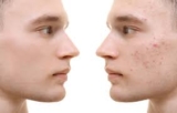 How Dubai’s High-Tech Acne Treatments Are Changing the Skincare Game
