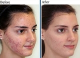How Laser Scar Removal in Dubai Works: Techniques and Technology Explained