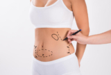 Understanding the Costs Associated with Liposuction