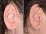 How Long Does It Take to Recover from Earlobe Surgery in Dubai
