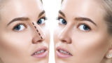 How Long Does It Take to Recover from Rhinoplasty in Dubai