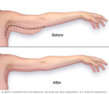 How Much Does Arm Lift Surgery Cost in Dubai, and Is It Worth It