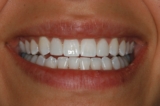 How Non-Prep Veneers Can Fix Gaps, Chips, and Stains in Your Teeth
