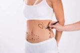 How Painful Is a Tummy Tuck What to Expect During and After Surgery