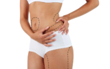 How Safe is Liposuction in Dubai? Everything You Should Consider