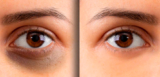 How to Get Rid of Dark Circles in Dubai Expert Insights and Treatments
