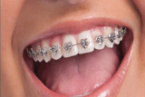 How to Keep Your Braces Sparkling Clean: Best Cleaning Tools