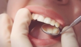 How to Maintain the Longevity of Your Composite Fillings