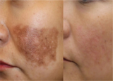 How to treat unwanted pigmentation