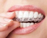 Clear Aligners and Facial Symmetry: Impact on Overall Appearance
