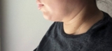 Is Double Chin Liposuction Effective for Loose Skin?