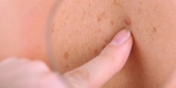 Is Skin Tag Removal a Permanent Solution?