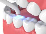 Is There a Difference Between White Fillings and Composite Fillings