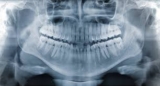 Is a Panoramic Dental X-Ray Necessary for Wisdom Tooth Extraction
