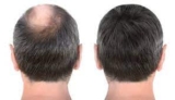 Is the Procedure Safe for a 1 Dirham Hair Transplant in Dubai