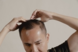 Finasteride: A Solution for Hair Loss
