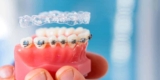Life After Braces: How to Maintain Your New Smile