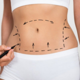 Discover the Best Liposuction Techniques for a Sculpted and Contoured Body