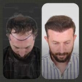 Is a Male Hair Transplant in Dubai Right for You Key Considerations