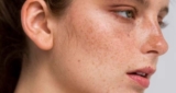 Melasma Solutions That Work: Expert-Approved Treatments