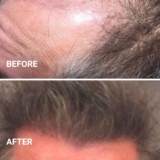 Best Hair Transplant Surgery in New York: Top Clinics & Specialists