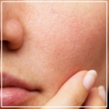 How to Find the Best Open Pores Treatment in Mumbai?